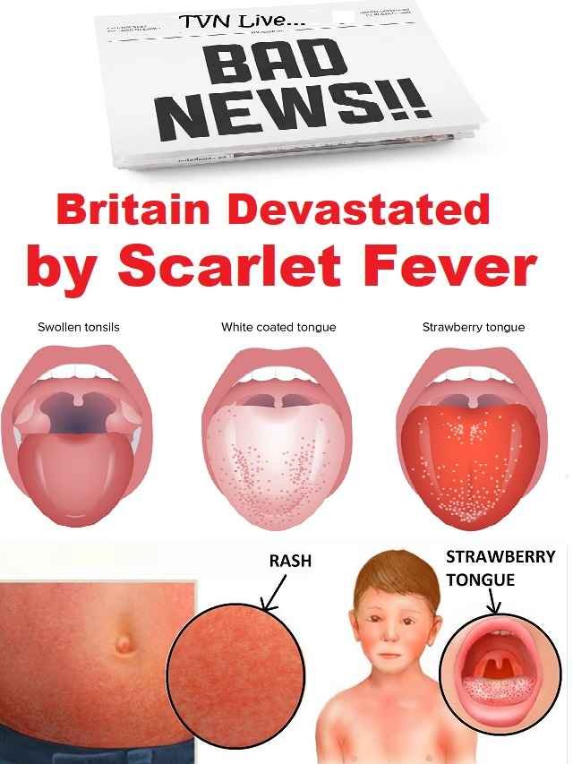 Scarlet fever outbreak in Britain