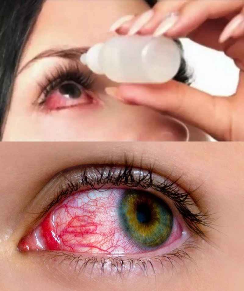 Red Eye Flu Home remedies